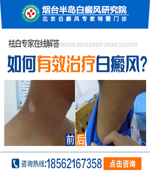 烟台白癜风医院